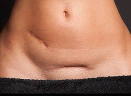 C Section Scar Photos