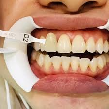 Cara tercepat untuk putihkan gigi kuning adalah dengan mencuci gigi di klinik. Harga Putihkan Gigi Di Klinik Kerajaan