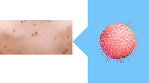 Vaccine researcher maurice hilleman and his group had long been working on a chickenpox vaccine; Chickenpox Vaccine Side Effects Toddler 10 Side Effects