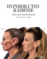 Hyperdilute Radiesse