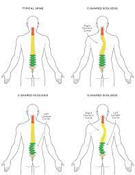 Yoga is the most ancient and effective form of treatment for correction of scoliosis or spinal curvature which not only helps physically but also mentally to cope up with this painful condition. Scoliosis And Yoga The Do S And Don Ts