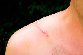 How To Avoid Scarring? 8 Benefits Of Wound Cares