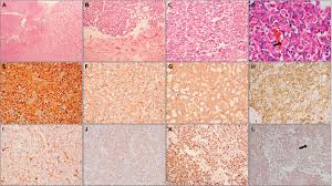 Or, the cause of a symptom may be a different medical condition that is not cancer. Atypical Teratoid Rhabdoid Tumors Challenges And Search For Solutions Cmar