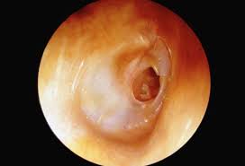 Tinnitus refers to the sensation of hearing sounds within the ear, such as ringing, rather than from outside of the ear. Ear Infection Symptoms Causes And Treatment
