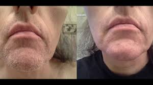 Electrolysis also takes a lot longer to treat the same sized area, prolonging the agony. Removing Hair Electrolysis Before And After Youtube
