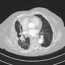 The result is a detailed 3d model image of the scanned tissue. Malignant Pleural Mesothelioma Radiology Case Radiopaedia Org