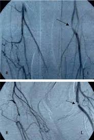 Angiografie Van De Onderste Ledematen Boven Anteroposterior Onder Download Scientific Diagram