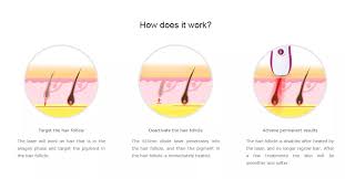This permanent hair removal device reviews made with lightweight technology, which assures you a long time useable this product. Wholesale Tria 4x System Laser Hair Removal At Home Reviews Buy Laser Hair Removal At Home Reviews Laser Hair Removal At Home Tria Tria Laser Hair Removal System Product On Alibaba Com