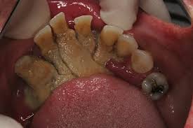 Dental plaque is the covering of a film of bacteria and sugar formed on your teeth and is the main cause of gum disease. What Is This Stuff Growing In My Mouth Columbia Sc Dentist