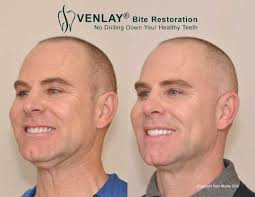 Check your teeth alignment by biting down invisalign is designed to straighten teeth but it can also be used to correct overbite without surgery. Overbite Correction Sam Muslin Dds