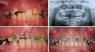 Mesiodens are supernumerary teeth, commonly seen in the maxillary midline. Clinical Recommendations For Management Of Mesiodens And Unerupted Permanent Maxillary Central Incisors Springerlink