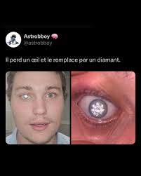 Après avoir perdu son œil droit à cause d'une maladie, Slater Jones,  bijoutier américain, a décidé d'en faire une œuvre d'art. Plutôt qu'une  prothèse classique, il a choisi d'y intégrer un diamant