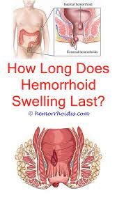 How Long Do Hemorrhoid Flare Ups Last Bleeding Hemorrhoids Hemorrhoid Remedies Cure For Hemorrhoids