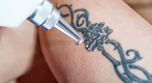 Since 2010, more than 2,000 people have had tattoos removed by the nhs, which has cost over £330,000. Laser Tattoo Removal In Inverness