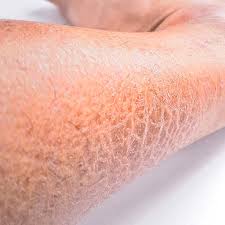 Image result for Ichthyosis