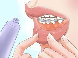 This is what you need to know about an expander. 4 Ways To Deal With A Palate Expander Wikihow