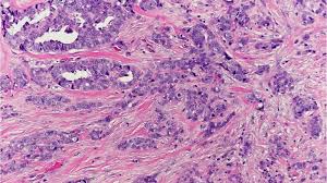 Breast cancer is not just one disease, but rather is a general term used to describe a number of different types of cancers that occur in the breast. Types Of Breast Cancer Breast Pathology Johns Hopkins Pathology