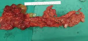 Also referred to as benign multicystic mesothelioma, benign cystic mesothelioma, and bmpm, this type of peritoneal mesothelioma is most common in women of . Asymptomatic Peritoneal Carcinomatosis Originating From Benign Cystic Peritoneal Mesothelioma Ecancer