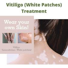 In the case of vitiligo, you may also have white skin patches in your pubic. Vitiligo White Patches Treatment Skin Hair And Pain Treatment