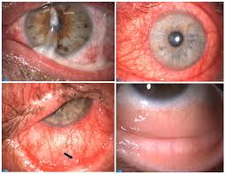 Image result for Acute Red Eye