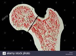 What if we could create custom bone implants that would trigger their own replacement with real bone? Bone Cross Section Stockfotos Und Bilder Kaufen Alamy