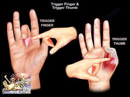 Image result for Trigger Finger