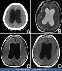 Image result for Normal Pressure Hydrocephalus