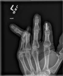 Image result for Interphalangeal Dislocation