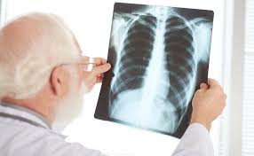 Igra Para Diagnostico Da Tuberculose Latente Abcd