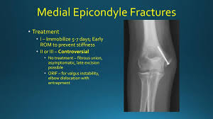Operative treatment of medial epicondyle fractures in children. Management Of Pediatric Fractures Ppt Download