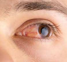 Image result for Allergic Conjunctivitis