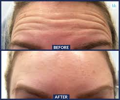 Most patients begin to notice an effect three to five days after their injections, with full results becoming visible after 14 days. How Long For Botox To Take Effect Arxiusarquitectura