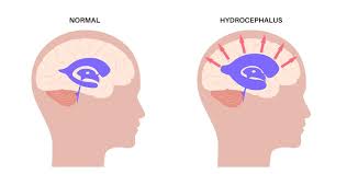 Image result for Hydrocephalus