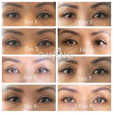 Pin On Eyelid Surgery