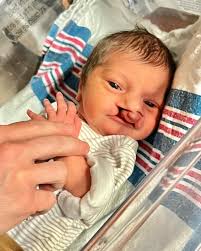✨ Family Spotlight ✨ “At our 20-week sonogram, we found out our baby would  have a bilateral cleft lip and palate. We spent the second half of the  pregnancy worrying about the