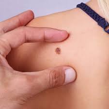 Merkel cell carcinomas are rare and potentially aggressive forms of skin cancer. Merkel Cell Carcinoma Skin Cancer Rates Rising In U S Allure