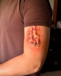 Fatma Azaiez | I think its a Little infected 🤭 HF Acid burn What do u guys  think ? | Instagram