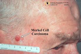 Image result for Merkel Cell Carcinoma