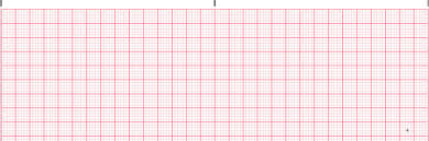 Electrographically documented history of psvt (e.g., electrocardiogram ecg obtained during an if patient had a prior ablation for psvt, patient must have documented ecg evidence of psvt. Supraventricular Tachycardia
