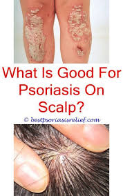 Typesofpsoriasis Psoriasis Hurts Dieta Para Psoriasis Cuero Cabelludo Psoriasisonlegs Psoriasis Von Zumbusch What Psoriasis Psoriasis Causes Scalp Psoriasis