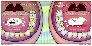 Image result for Candidiasis