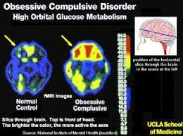 We Are Not All A Little Bit Ocd Psychology Today