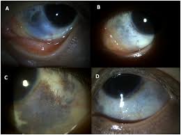 Image result for nevus sclerae