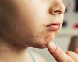 Image result for Impetigo