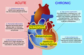 The possible pathophysiology and proposed guideline. Recognizing Covid 19 Related Myocarditis The Possible Pathophysiology And Proposed Guideline For Diagnosis And Management Sciencedirect
