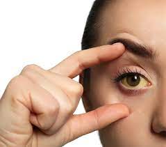 Jaundice Treatment Cost in Pune, India | Liver Surgery India