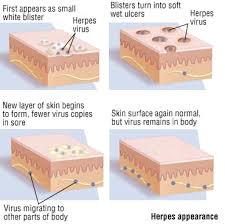 Image result for genital herpes