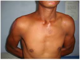 Image result for SC Dislocation