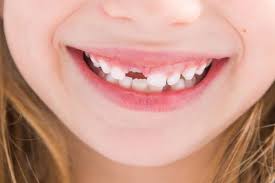 Leider hat er nicht rechtzeitig daran gedacht eine zusatzversicherung abzuschließen. Saudi Aramco Blog Zahn Abgebrochen Zahnfleisch Druber Gewachsen