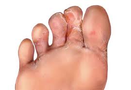 Check spelling or type a new query. Athlete S Foot Tinea Pedis Perform Podiatry